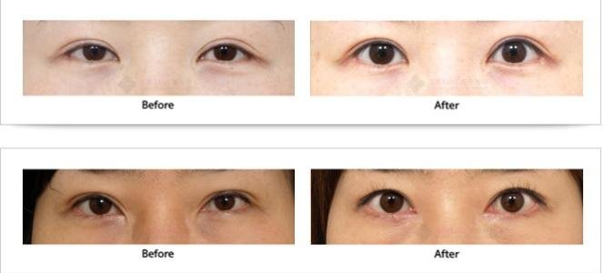 韩国双眼皮整形失败后哪家整容医院的修复手术好?价格是多少钱?