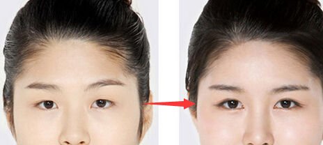 南宁韩式双眼皮修复哪家整形整容医院最好?手术价格是多少钱?