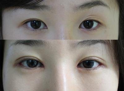 上海脸部整形整容手术_整形术手术过程图片_脸部整形前后对比图