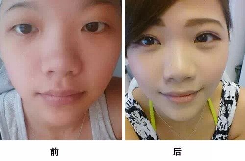 上海脸部整形整容手术_整形术手术过程图片_脸部整形前后对比图