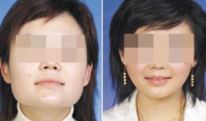 郑州_深圳整容医院做微创下颌角瘦脸整形手术哪家最好?效果如何?