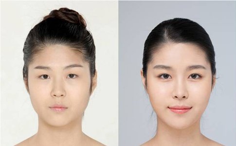 西昌_青岛注射一次botox瘦脸针整形手术的价格费用一般是多少钱?