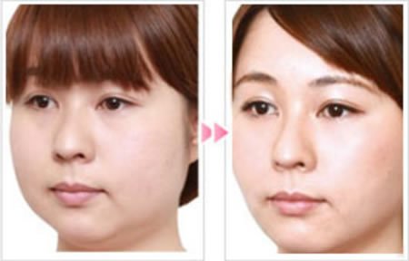 重庆_杭州_合肥哪家_哪个整容医院做无痛吸脂瘦脸整形手术比较好?