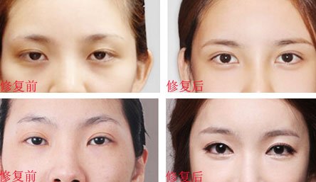 济南_西安做韩式四点双眼皮修复最好的整形医院_手术费多少钱呢?