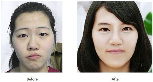 西安_北京那个医院做唇裂整形后疤痕修复手术价格费用是多少钱?