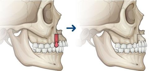 广州轻微骨性外突嘴部怎么矫正?整形手术的费用大概要多少钱?