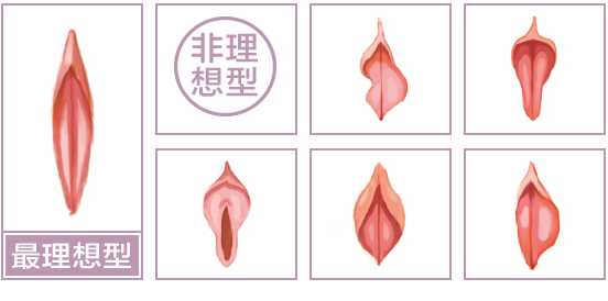 上海好的妇科医院怎么做大_小阴唇整形修复手术?需要多久能恢复?