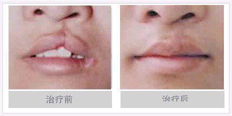 广州_北京整形医院儿童嘴部唇腭裂疤痕修复手术价格要多少钱?