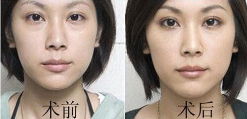 北京_重庆脸部微整容整形医院微创吸脂瘦脸手术大概要多少钱啊?