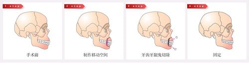 中国西安_浙江嘴巴前部骨骼突出矫正整形整容费用一般要多少钱?