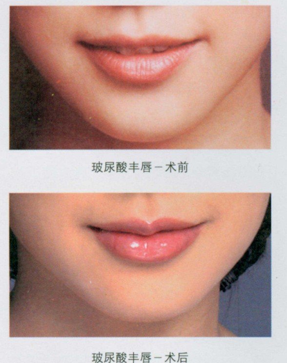 上海_南京_台州的整形美容医院打玻尿酸丰嘴唇_唇部整容哪个较好?