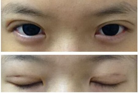 福州内双做开眼角加抽脂埋线双眼皮整形手术的价格是要多少钱?