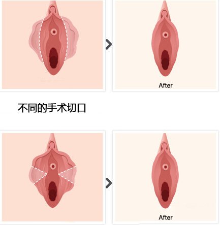 郑州_广州_上海女人做小阴唇肥大整形手术的最低费用价格多少钱?
