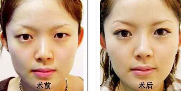 长沙整形医院_上海九院做韩式双眼皮_眼睛修复美容手术费多少钱?