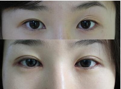 韩国_杭州_成都整形医院怎么做韩式无痕双眼皮手术?手术多少钱?