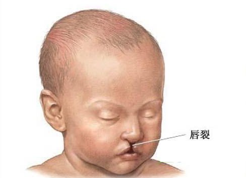 成都_广州_上海九院整形医院做唇腭裂鼻子修复手术价格多少钱?