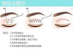 上海最好整容医院眼部做韩式无痕抽脂双眼皮整形手术价格多少钱?