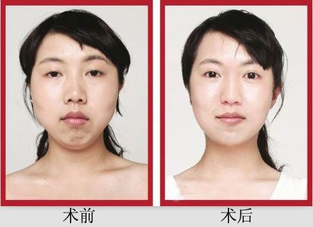 重庆_合肥_成都_福州整容整形医院双眼皮手术失败赔偿多少钱?