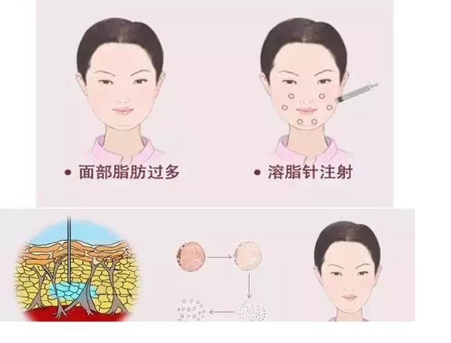 福州_武汉_北京哪家医院注射打溶脂瘦脸针的效果最好?哪里便宜点?