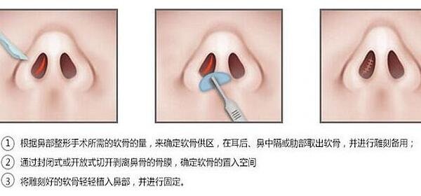 连云港_郑州整形医院做自体组织隆鼻整容手术的费用是多少钱呢?