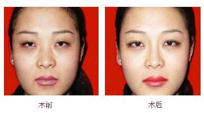 上海九院耳软骨垫鼻尖_鼻头塑形整容手术价格一般是要多少钱?