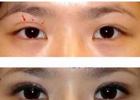 成都韩式微创_埋线双眼皮修复手术价格多少钱?谁做过?哪家医院好?