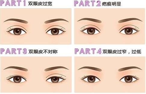 上海韩式微创双眼皮修复整容整形医院哪家好?手术价格是多少钱?