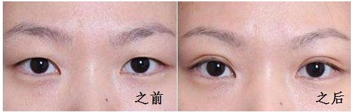 杭州韩式微创双眼皮修复整形整容医院哪家好?手术价格是多少钱?