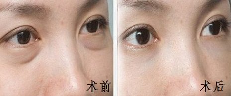 上海_广州_宁波激光无痕_超声波法去眼袋手术价格是要多少钱呢?