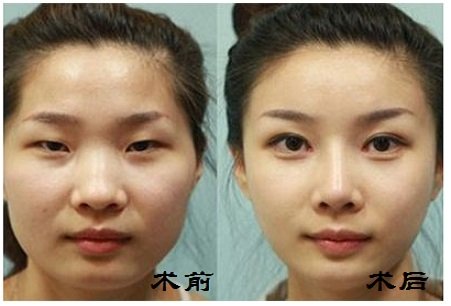 宁波_重庆好的整形医院开内眼角_疤痕整容修复手术费用是多少钱?