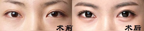 北京好的整形医院眼睛吸脂_激光修复眼睛整容手术价格费用多少钱?