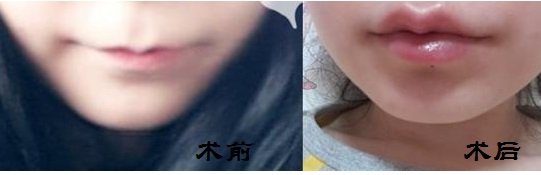 上海美莱_紫馨整形整容医院注射玻尿酸丰唇专业权威_安全可靠