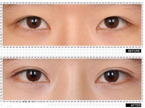 绍兴_温州_杭州的医院怎么做全切开式双眼皮恢复手术?价格多少钱?