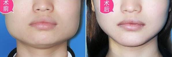 韩式自体脂肪填充下颌_全脸整容整形手术过程安全吗?移植成活率