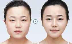 青岛 长沙 重庆做面部抽脂 吸脂瘦脸的整容手术哪家整形医院最好?