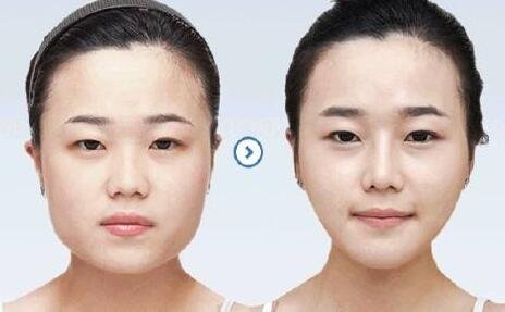 青岛_长沙_重庆做面部抽脂_吸脂瘦脸的整容手术哪家整形医院最好?