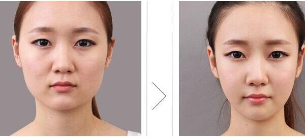 韩国胶原蛋白_埋线提升面部_脸部整容整形手术价格是需要多少钱?