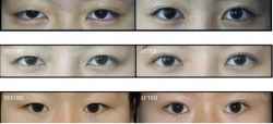 合肥整容医院的韩式全切双眼皮和埋线手术价格是多少钱?哪家最好?
