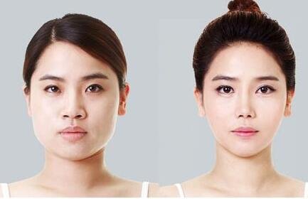 上海_南京华美打个最好的韩式瘦脸针需要的费用大概是多少钱呢?