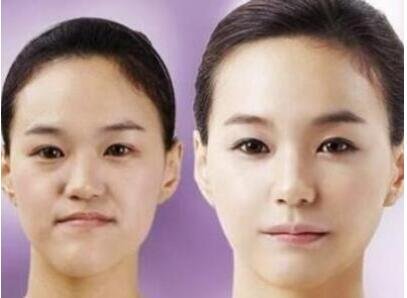 上海九院下颌骨矫正_脸部疤痕整容_botox注射瘦脸手术费用多少钱?