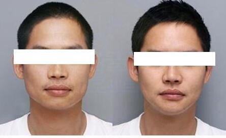 上海脸部整容医院填充苹果肌_打瘦脸针整形手术多少钱?价格表