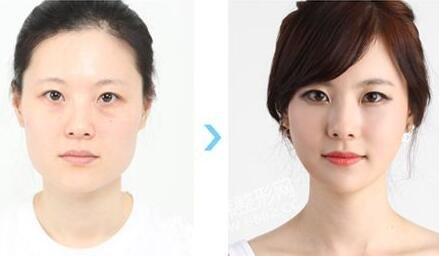 到韩国整形医院去做脸部轮廓整形_全脸整容手术价格需要多少钱啊