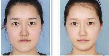北京注射瘦脸针微创整形哪家整容医院好?手术费用是多少钱?价格表