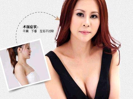上海假体丰胸的材料怎么选?哪种好?假体丰胸隆胸手术效果好不好?