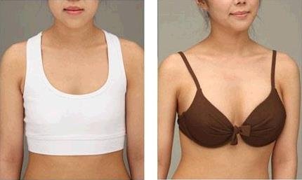 上海做自体脂肪移植_填充隆胸丰胸整形手术好吗?隆胸效果怎么样?