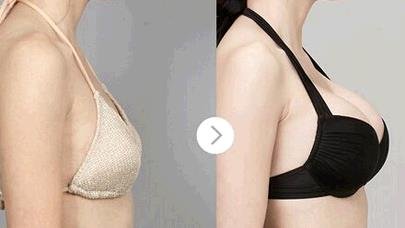 上海做内窥镜假体植入隆胸丰胸整形手术好不好?隆胸整形安全吗?
