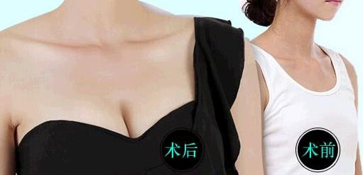 上海九院注射自体脂肪_抽脂_吸脂隆胸整形手术费用需要多少钱?