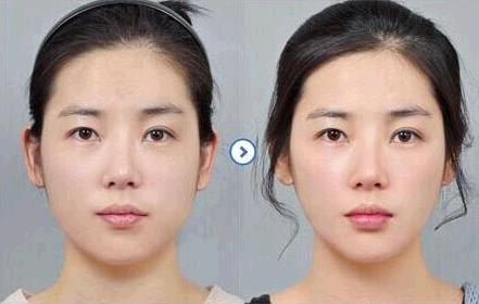 经期可以打瘦脸针么?打botox瘦脸针有哪些副作用?几个月效果最佳?