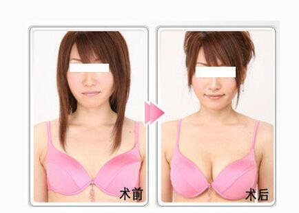 广州哪家医院自体脂肪隆胸移植比较好?丰胸效果好吗?优势有哪些?