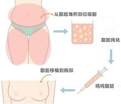 广州自体脂肪隆胸手术对身体有哪些危害?危害大吗?后遗症是什么?